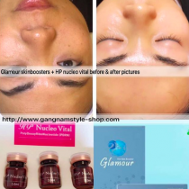 glamour skinboosters treatment before & after