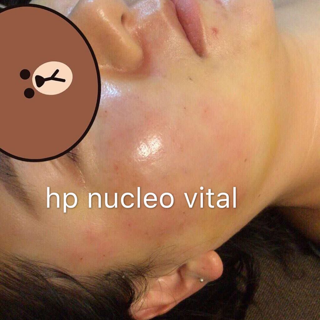 hp nucleo vital pdrn injection