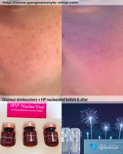 glamour skinboosters treatment before after