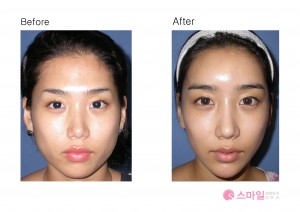 Korea fat transfer before & after