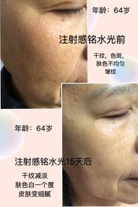Skinboosters before & after