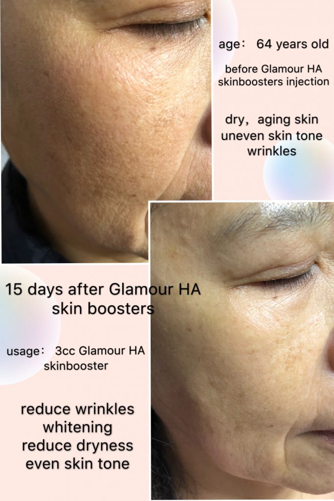 Skin Boosters HA injection before & after result Injectable Skin