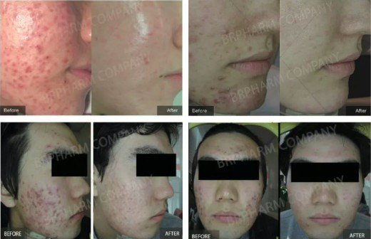 PDT photodynamic therapy acne treatment review 