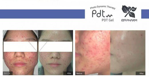 PDT photodynamic therapy before & after pictures