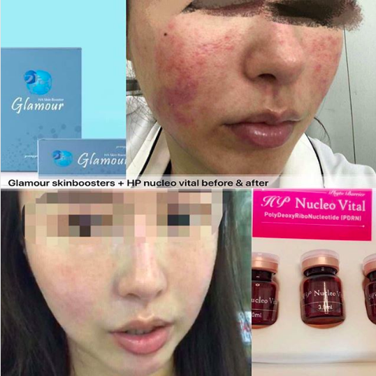 pdrn skin boosters injection before after pictures