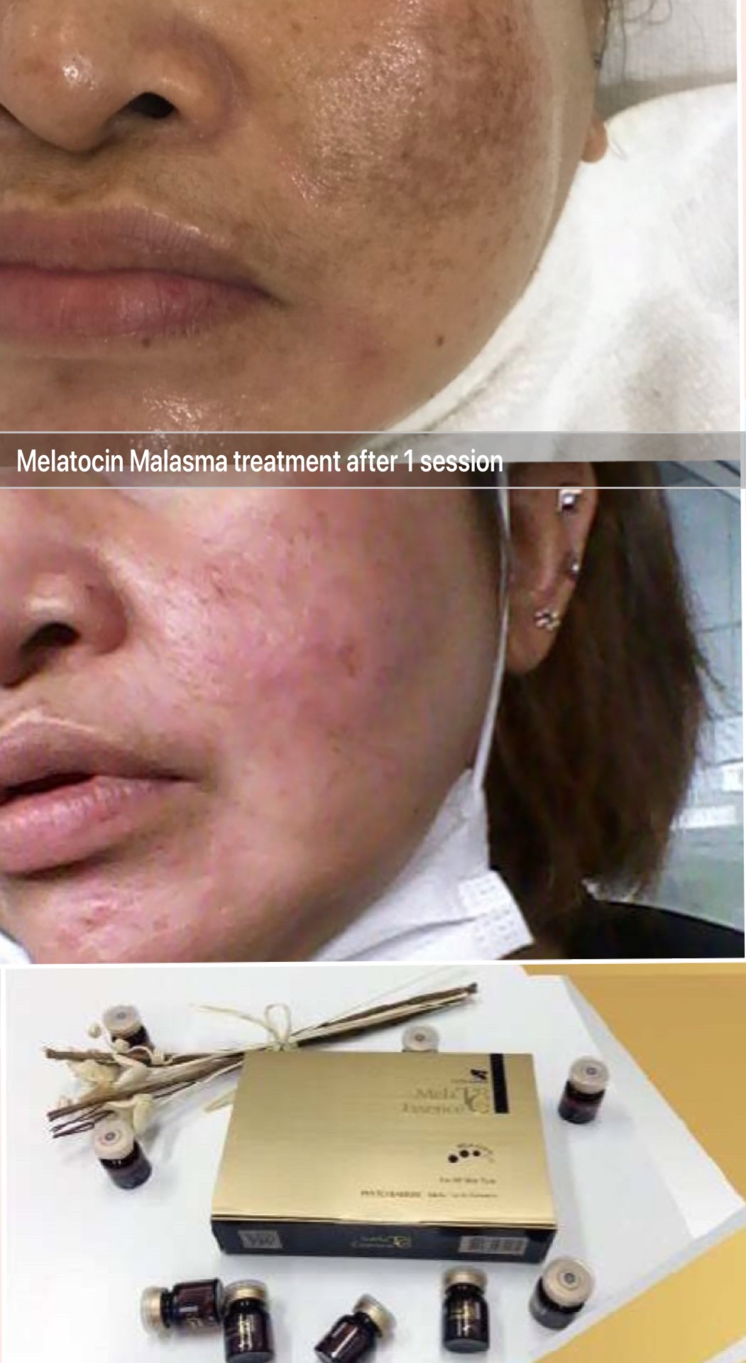 Easy melasma treatment Melatocin Essence with microneedling