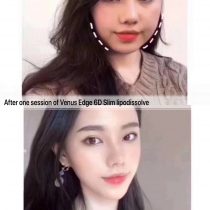 Venus Edge 6D Slim Lipodissolve injection before & after