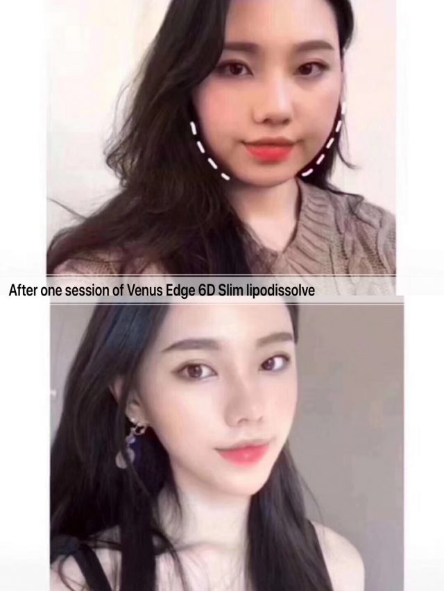 Venus Edge 6D Slim Lipodissolve injection before & after