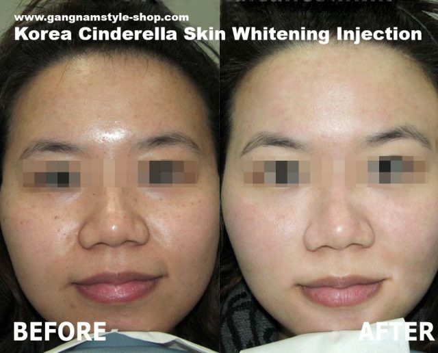 cinderella skin whitening injection before and after