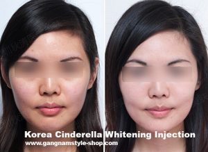 Korea Cindella skin whitening injection, most popular Glutathione injection